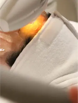 【小顔矯正】顔全体 別人級・切らないリフトアップ!短期間で憧れのVライン形成♪