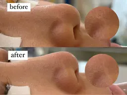 鼻ハイドラフェイシャル＋部分WAX1箇所 💎 ¥4,400→¥3,000