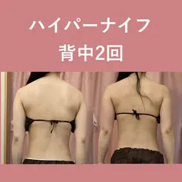 【選べる上半身or下半身45分】脂肪を燃やす!ハイパーナイフ痩身