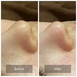 ハイドラフェイシャル　お試し　鼻