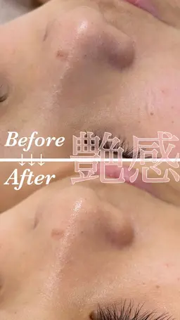 【肩こり/ほうれい線/毛穴/デトックス】背中リンパ＋フェイシャル＋岩盤浴