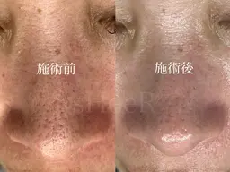 【お試し】いちご鼻・黒ずみ集中ケア✨鼻毛穴洗浄