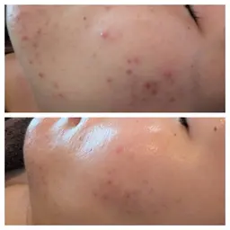 【年齢、本気改善】未来まで見据えたREVIハーブピーリング