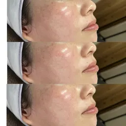 フェイシャルワックス脱毛