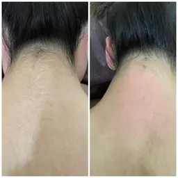 女性限定 各箇所(背中上、背中下、腕、太もも、膝下、胸、うなじ)BrazilianWAX＋光脱毛