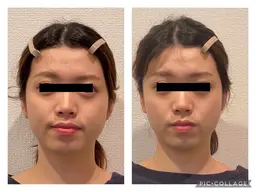 【小顔矯正コース】痛みもない施術で、小顔だけでなく頭から小さくします💡