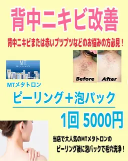 【背中ニキビ/毛穴ケア】背中ニキビケア MTピーリング＋泡パック 1回5000円