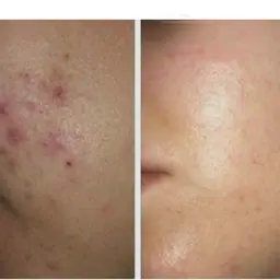 前回のお顔のハーブピーリングの施術から4週間以内の方⭐️フェイシャルハーブピーリング🌿