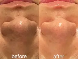 【ミニモ限定】 🌱毛穴レス/赤み/ニキビケア🌱艶肌+毒素デトックス ハーブピーリング 60分