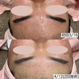 【ニキビ/肌荒れ】プラズマシャワー➕毛穴洗浄(鼻)