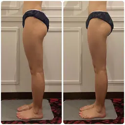 気になる脚に徹底アプローチ🔥ハイパーナイフEXとハイパーシェイプの最強の合わせ技★むくみ解消＆セルライト＆ヒップUP