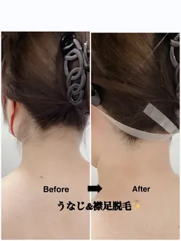 👱‍♀️うなじ&襟足脱毛👱‍♀️ ミニモ学割❗️30分平日学生限定🈹¥2,800→¥1,500