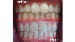 【ご新規様限定】黄ばみ汚れを落とす歯科衛生士のホワイトニング¥2,980ミニモ限定