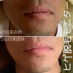 [初回]メンズヒゲ脱毛モニター💆🏻‍♂️※定員埋まり次第掲載終了⚠️メンズもツルスベ肌をスタンダードに❣️
