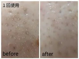 【特別価格】🧡小鼻集中エステ🧡超音波エステ付き 黒ずみ毛穴、ひらき毛穴、毛穴トラブルのないつるすべなお肌に