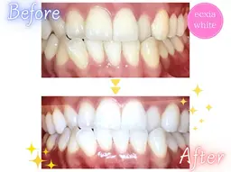 【3月限定特別クーポン🌸　継続率90%以上🦷✨】ホワイトニング【9分×2回】　¥7980→¥980 別途料金なし