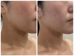 ✨新登場✨人気爆発フェイシャル🤩【ハイドロ✕Vリフト✕小顔ハンド】+【背中リンパマッサージ】のスペシャルメニュー