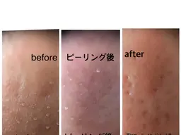 毛穴集中エステ