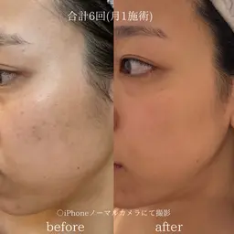 🌸新年度の準備🌸ノーファンデ肌へ✨️本気の肌質改善!🔥剥離•ダウンタイム有。シミ・ニキビ・ニキビ跡・透明肌に!