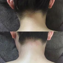 『アップスタイル美人』うなじ背中脱毛✨