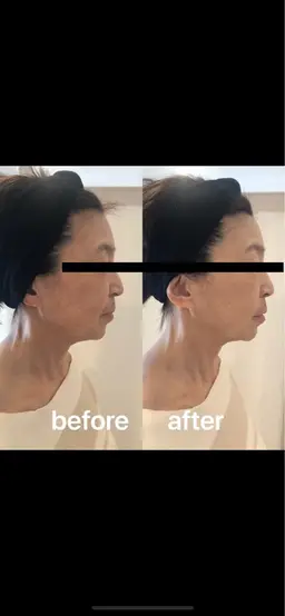 フルコース♪小顔リンパ筋膜デトックスエステ🧐選べる炭酸パック(有酸素運動)orEMS(筋トレ)