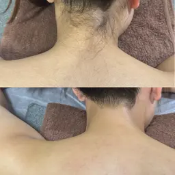 【女性🎀】うなじダブル脱毛+背中ワックス脱毛