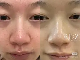 【30分で毛穴改善/促進🌿】小鼻ワックス+韓国肌質改善+プラセンタ美容液ケア💫