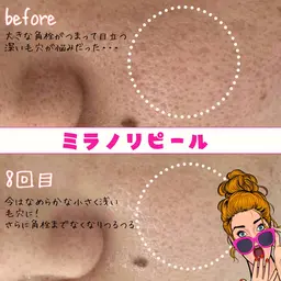 ミラノリピール全顔【2回目以降】