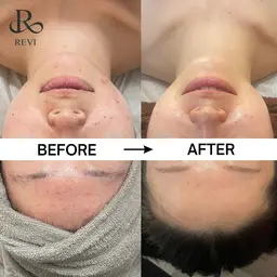 【ニキビ・ニキビ跡ケア】REVIハーブピーリング AI肌診断×陶肌パウダー＋IPSP幹細胞セラム入り🎁