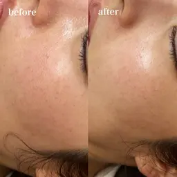 韓国美容✨【第四世代ピーリング🇰🇷全顔+首】