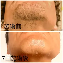 【当店人気 NO.1】 メンズヒゲ全体脱毛