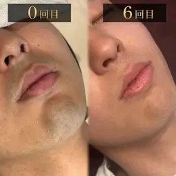 【プロ施術】清潔感を整えるメンズヒゲ脱毛 《脱毛範囲》口周り/頬/アゴ裏/