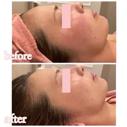 剥離あり🍃100%天然ハーブピーリング🍃植物幹細胞×ヒト幹細胞培養液配合!シミ・ニキビ・タルミ・しわなどの悩み解消✨