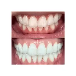 【人気】✨ホワイトニング40分+鼻毛脱毛3分✨…歯を白くして、ハミ出た鼻毛を根こそぎ無くす👃 メンズ人気