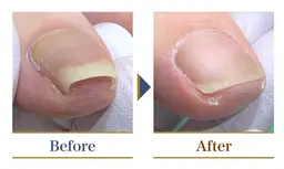 限定10名様 巻き爪補正(1爪)予約時利用条件:お写真の撮影・口コミ投稿にご協力頂ける方※2爪目からは通常価格