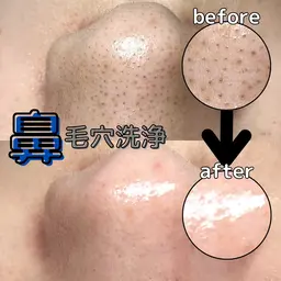 特別価格✨️🍓同時施術可能🍓【鼻だけ!👃毛穴洗浄💧】⏰45分