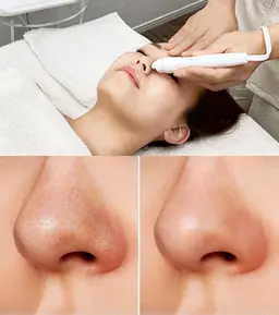 毛穴洗浄コース¥13,200→¥5,500
