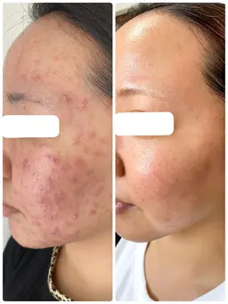 小顔&美肌のW効果💗【超音波エステ】