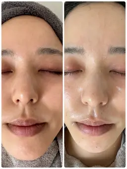 【REVI】陶肌トリートメント【剥離なしハーブピーリング】