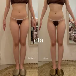 脚痩せ集中45分施術🥺🔥超高周波ラジオ波・キャビ・吸引🌸本気で変わりたい方向けクーポンの為遠方の方お断り🙇‍♀️