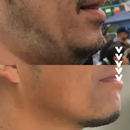 ジェルなし最新脱毛器でお肌に密着!しっかり抜ける!!打ち漏れなし!!!メンズヒゲ脱毛