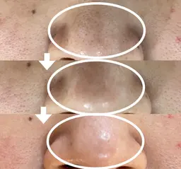 つるんと韓国肌【毛穴・黒ずみ・角栓ケア】高濃度炭酸ガス カーボキシーフェイス¥11,000→¥6,600