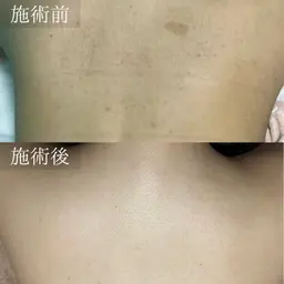 【限定クーポン⭐︎】人気No1👑全身脱毛(顔・VIO込み)¥5,000温ジェル使用