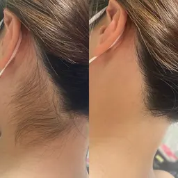 うなじシェービング+光脱毛