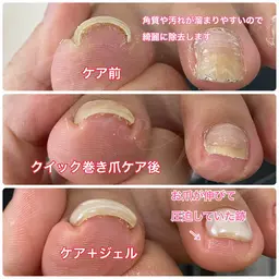 巻き爪ケア+Footワンカラー⚠️注意事項をお読みいただきご理解の上ご予約ください。