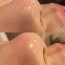 学割U24🌼ハイドラ毛穴洗浄