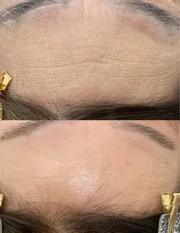 フェイシャル脱毛