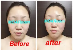 顔のむくみ・くすみとり( ¨̮ )