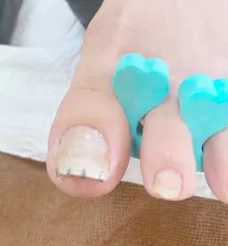 巻き爪矯正