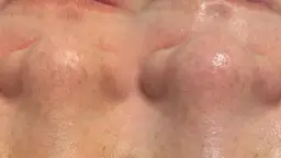 【浮かせて吸い取る】毛穴洗浄